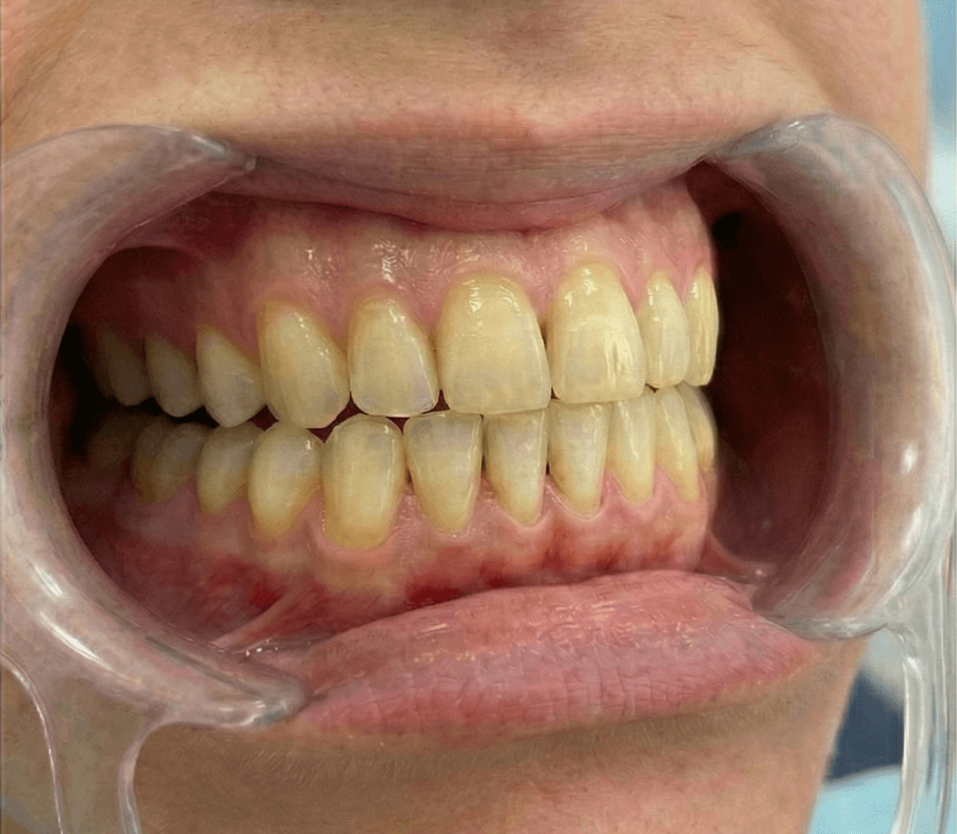 Dientes antes del blanqueamiento profesional