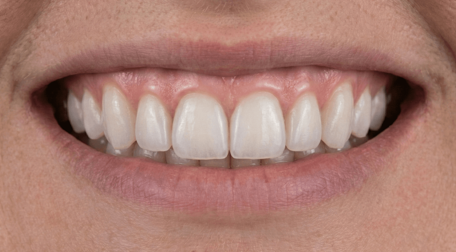 Carillas de Porcelana