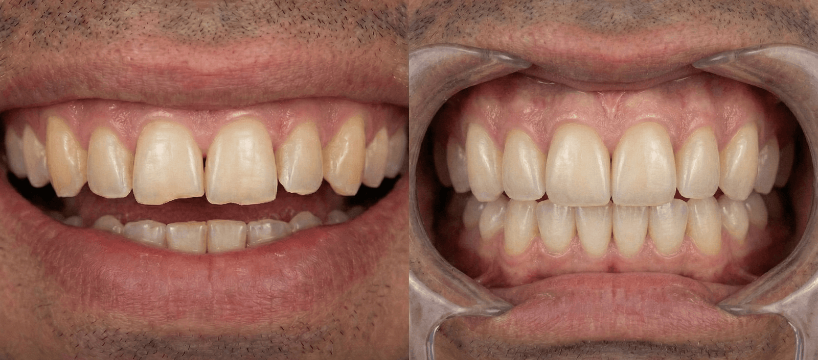 Carillas de Resina Inyectada