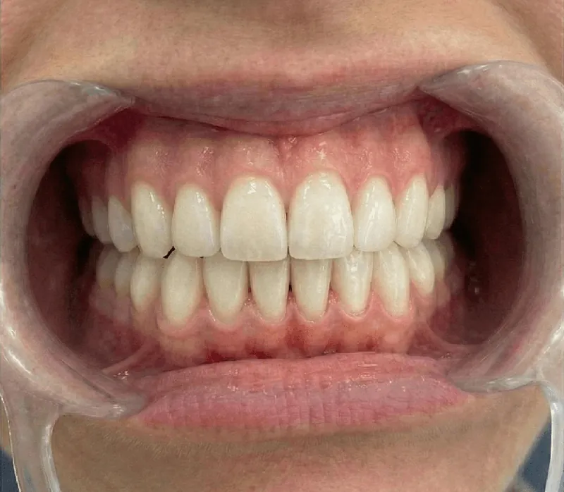 Dientes después del blanqueamiento Zoom 8 tonos menos